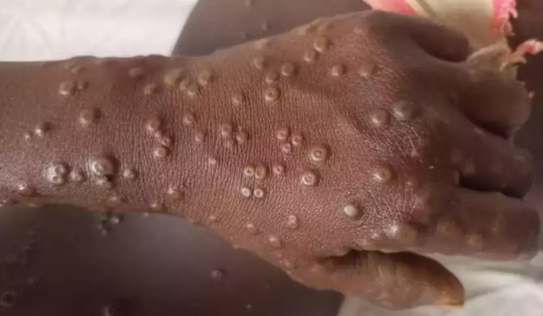 India’s First Case of Mpox Clade 1b Variant Reported: Know What is Mpox and How Dangerous is It