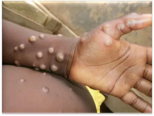 Death toll from monkeypox in Africa nears 1,000 as cases exceed 38,000