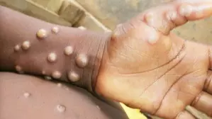 Uganda reports 49 new mpox cases