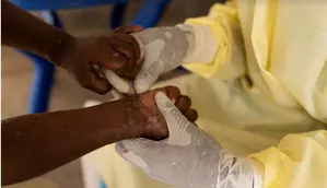 Uganda confirms first mpox death as infections rise to 164