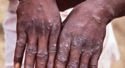 Ugandas health ministry warns of increasing monkeypox cases