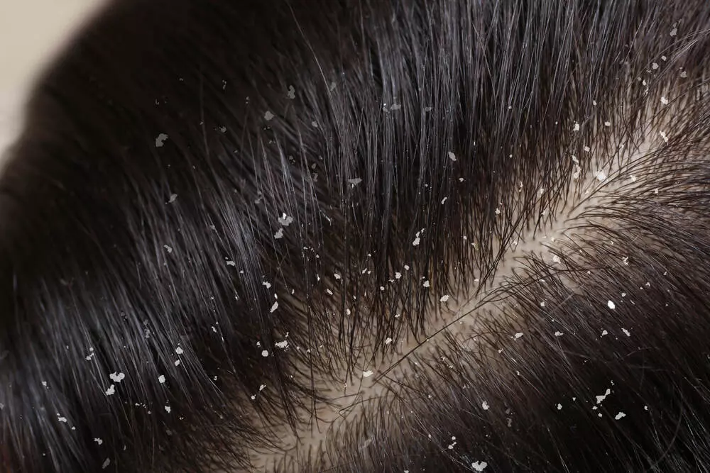 Are you troubled by dandruff during the winter? Follow these simple and effective home remedies to get rid of it