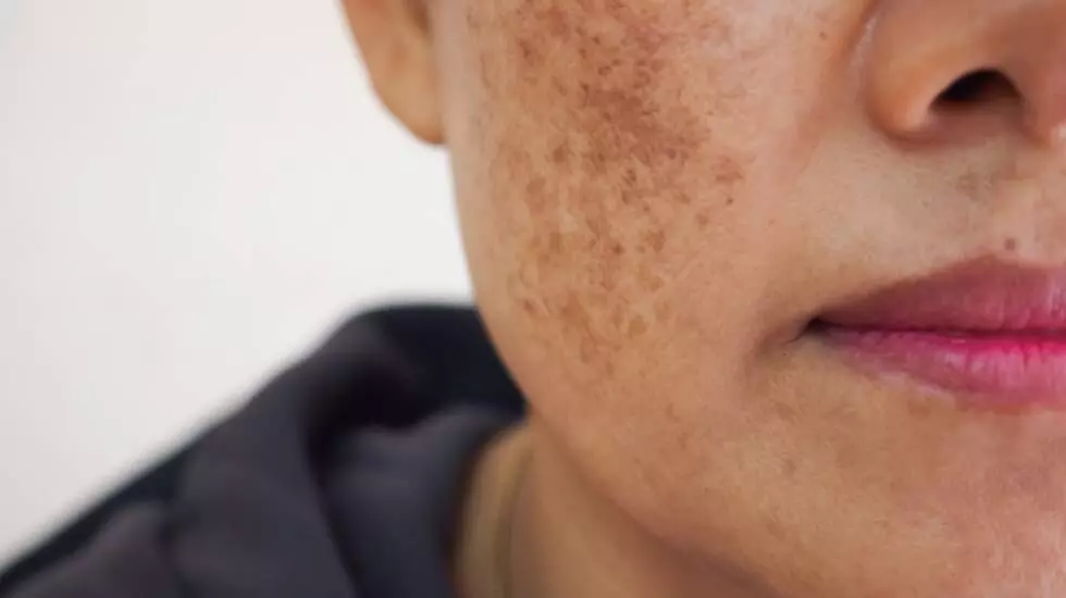 Skincare Tips: Troubled by freckles on your face? 5 home remedies to get rid of it