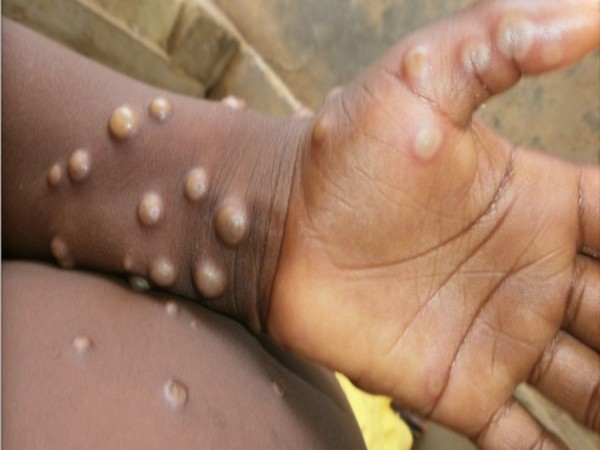 India confirms second case of Monkeypox: Heres all you need to know about the infection